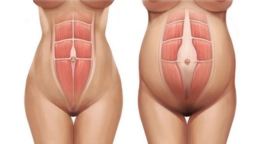 Ilustração da diástase dos músculos retos abdominais