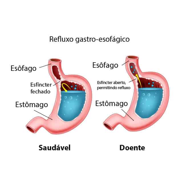 Doença do Refluxo