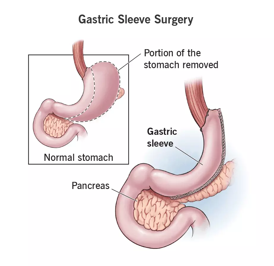 Anatomia do Sleeve Gástrico